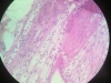 acute-inflammation-3