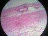 acute-inflammation-4