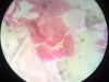 amyloidosis-1