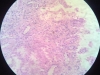 amyloidosis-4