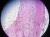 calcification-1