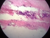 calcification-2