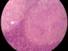 caseous necrosis-5