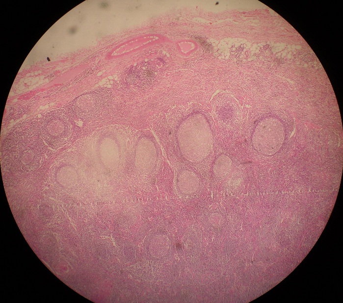 Chronic Granulomatous Inflammation