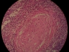 chronic-granulomatous-inflammation-40x