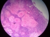 chronic-granulomatous-inflammation-5