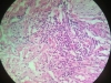 chronic-inflammation-1