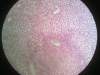 liver-congestion