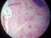 pulmonary-edama