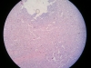 spleen-congestion-2