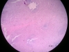 spleen-congestion-4