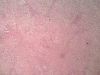 fatty liver-4x