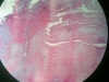 fibrocartilage-4