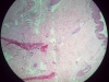 granulation-tissue-4