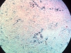 hemosiderosis-3