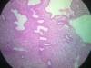 hyperplasia-1