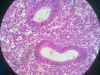 hyperplasia-2