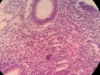 hyperplasia-7