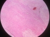 leiomyoma-2