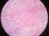 leiomyoma-3