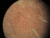 leiomyoma-4