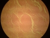 leiomyoma-5