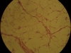 lipoma-3-40x