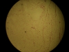lipoma-4-4x