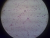 lipoma-5