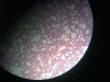 lung-1