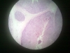 palatine-tonsils-1