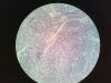 palatine-tonsils-4