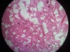 pulmonary-edema-4x