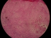 squamous-cell-carcinoma-4x