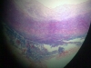 vein-3
