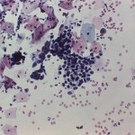 Adenocarcinoma of vagina
