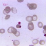 Plasmodium falciparum ring form