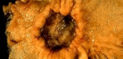 Classification of tumors