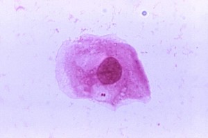 Neisseria meningitidis