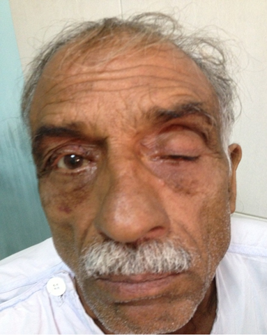 Ptosis