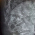 osteoporosis