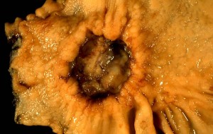 Adenocarcinoma of Stomach