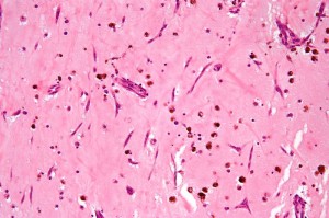 Atrial myxoma