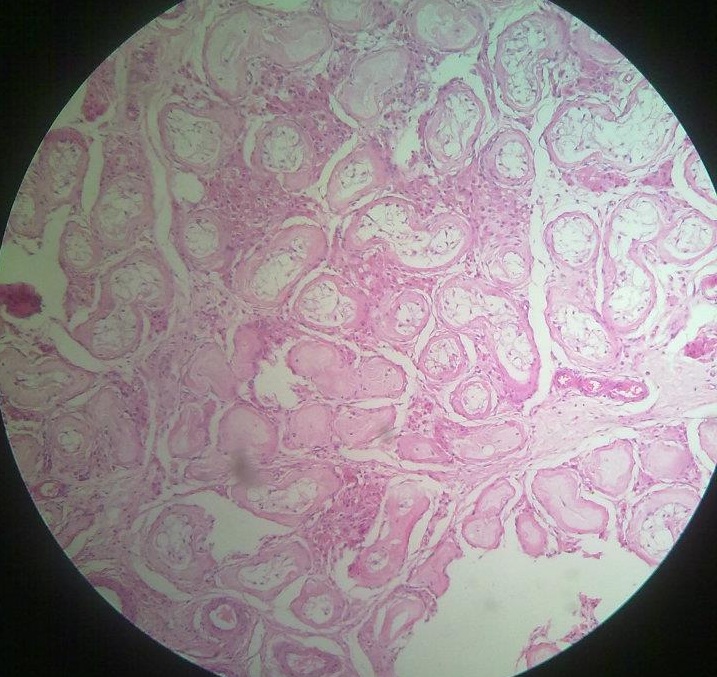 Atrophy of testes