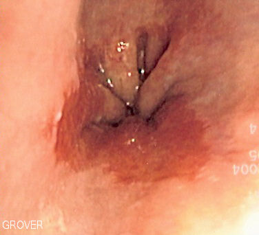 Barrett esophagus