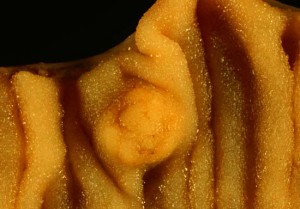 Carcinoid tumor of small intestine