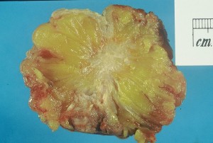 Ductal carcinoma
