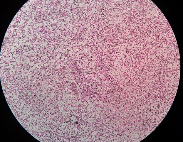 Fatty liver
