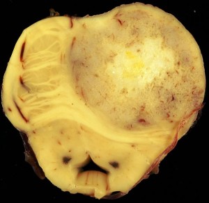 Gemistocytic astrocytoma