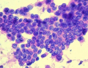 Papillary carcinoma thyroid